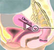 Cervical Cancer Video
